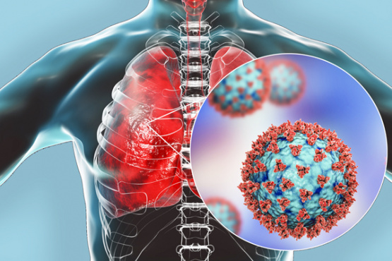 Восстановительная терапия после пневмонии, вызванной коронавирусом